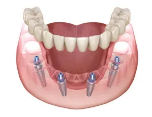 All-on-4 Neodent