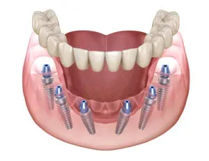 All-on-4 Straumann