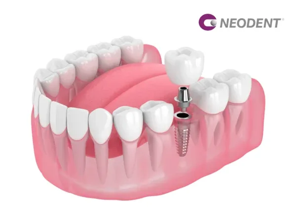 Implant dentar Neodent