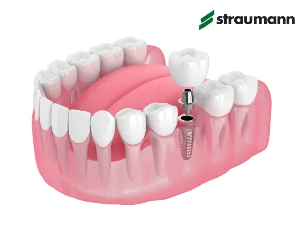 Implant dentar Straumann