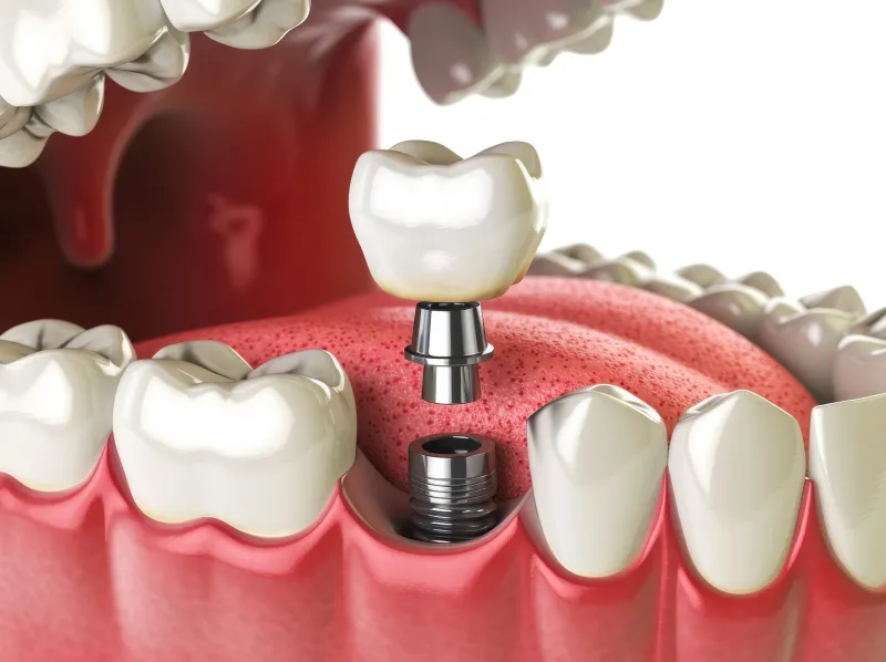 Coroană metalo-ceramică cu schelet metalic acoperit de ceramică