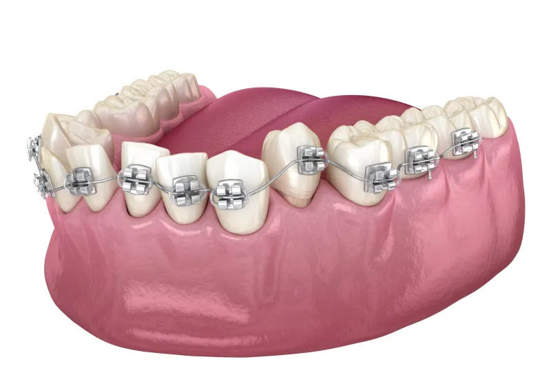 Ortodont în București aplicând un aparat dentar fix la clinica Davident din Sectorul 6