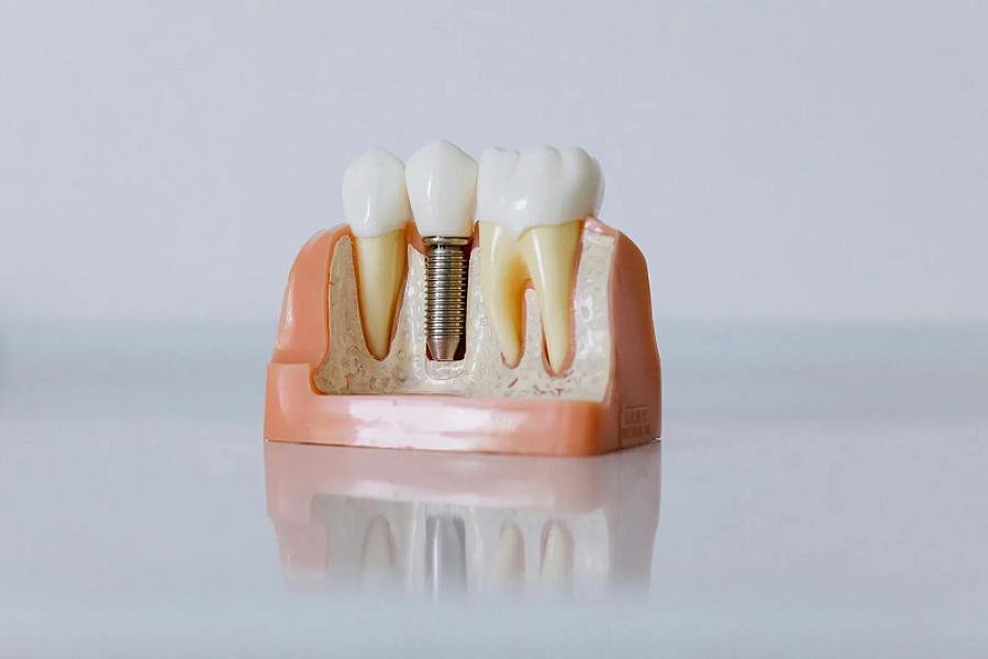 Ghidul chirurgical – precizie maximă în implanturi dentare