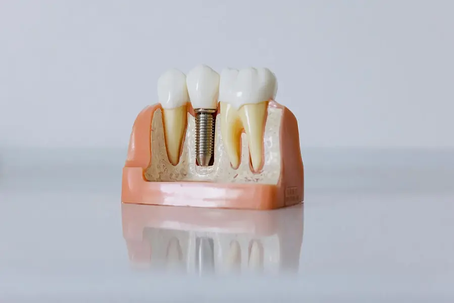 Ghidul chirurgical – precizie maximă în implanturi dentare