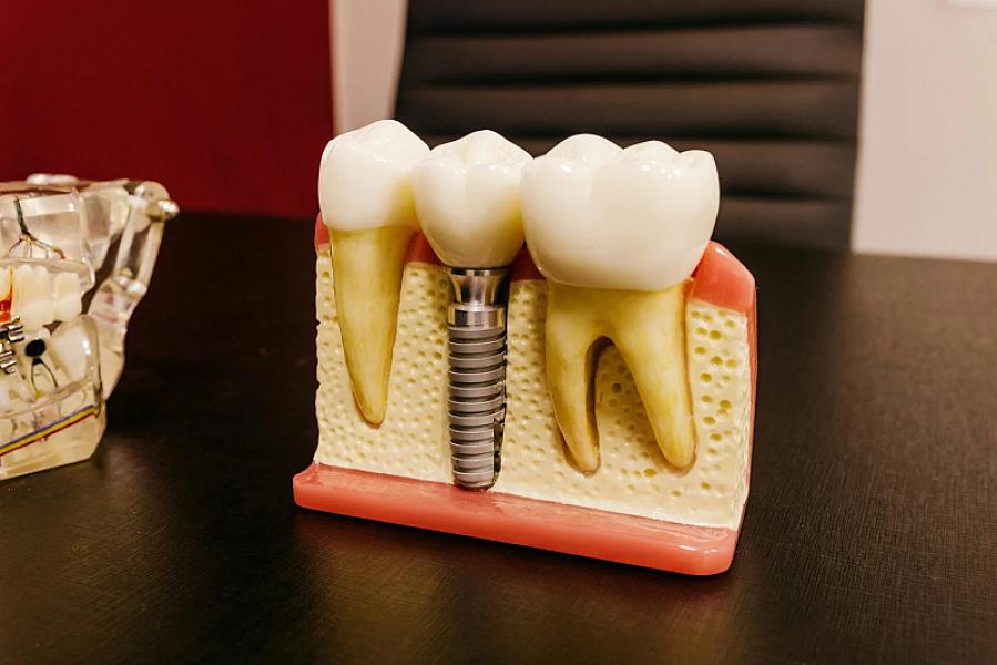 Importanța inserării implantului dentar în aceeași zi cu extracția dentară