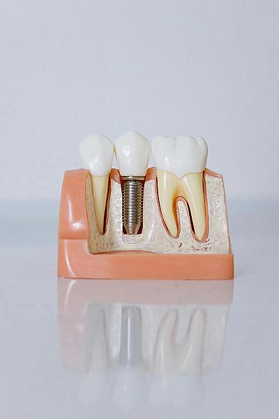 Care este diferența dintre un implant dentar și un dinte natural?