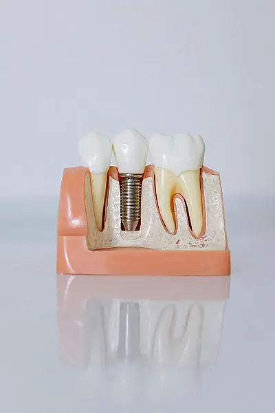 Care este diferența dintre un implant dentar și un dinte natural?