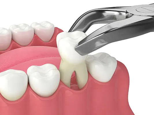 Chirurgie Orală la DaviDent Aesthetics, Sector 6 București