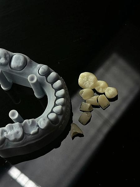 Când se poate fractura un implant dentar? Cauze, riscuri și prevenție