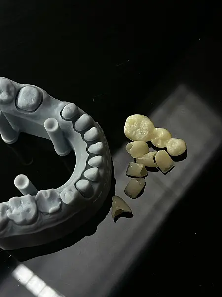 Când se poate fractura un implant dentar? Cauze, riscuri și prevenție