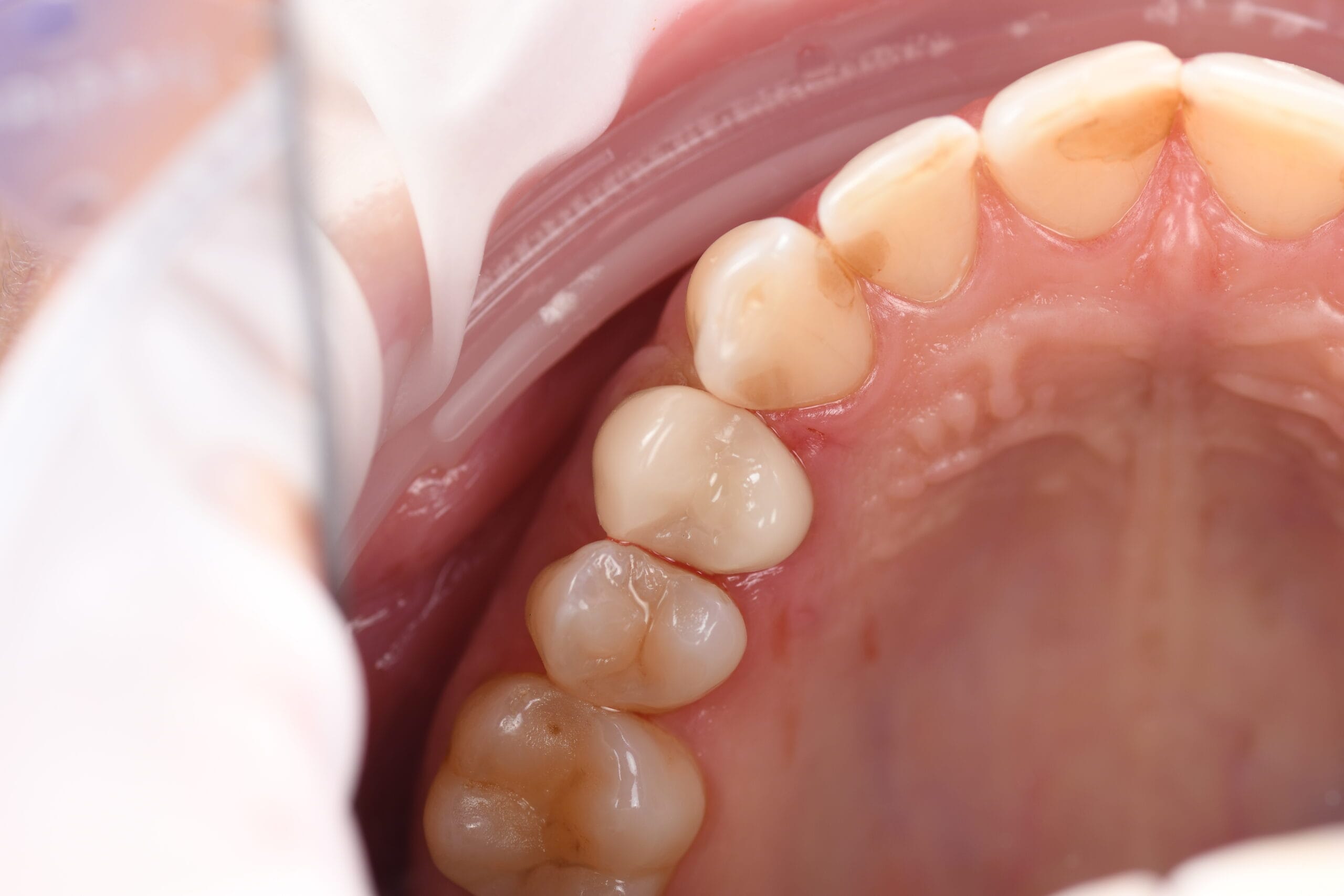 Echipa Davident în cadrul acestui cabinet stomatologic sector 6, oferind servicii complete de stomatologie sector 6  Suntem un dentist drumul taberei de încredere, activând într o clinica stomatologica sector 6 modernă  Vizitați ne la acest cabinet stomatologic drumul taberei pentru soluții oferite de un dentist sector 6 experimentat  Davident este o clinica dentara sector 6 și un cabinet stomatologic sector 6 drumul taberei dedicat sănătății tale prin servicii de stomatologie drumul taberei la standarde înalte 